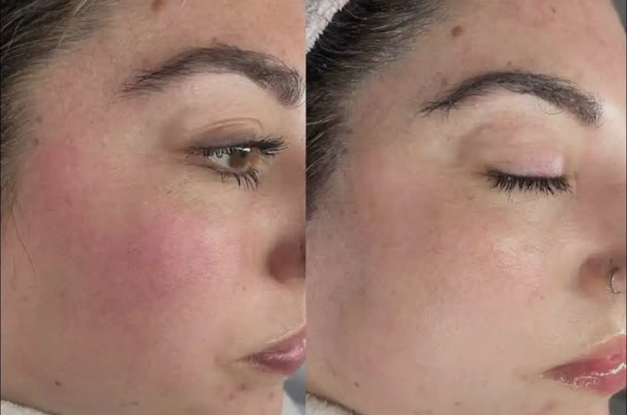 Comparativa del rostro con mejora de rojeces, textura y uniformidad tras un tratamiento Piel en Equilibrio.