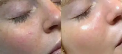 Comparativa de la mejilla antes y después de un tratamiento facial con mejora de manchas.