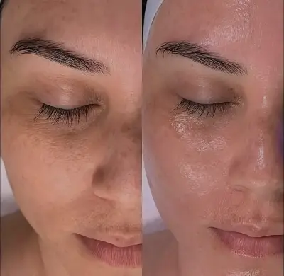 Comparativa del rostro antes y después de un tratamiento Vegan Glow Facial.