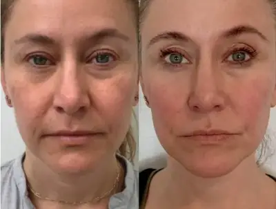 Comparativa facial antes y después de un tratamiento ExoVita Élite para revitalizar la piel.
