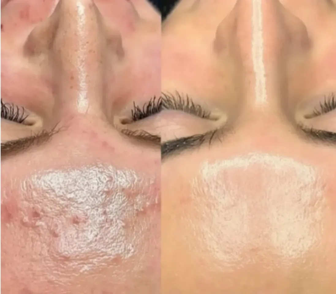 Secuencia facial durante una limpieza y tratamiento purificante de la piel.