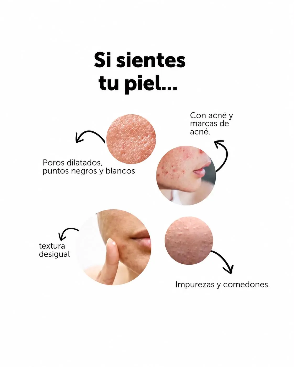 Infografía sobre poros dilatados, puntos negros, textura desigual, impurezas y comedones.